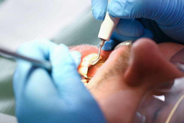 Best Emergency Tooth Extraction in Upper Sandusky, OH