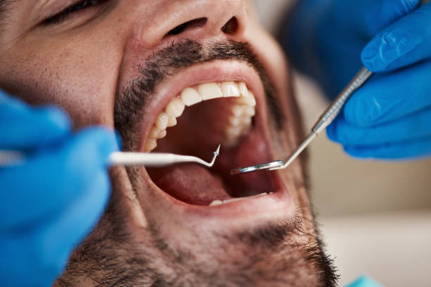 Best Emergency Treatment for Dental Infections or Abscesses in Upper Sandusky, OH